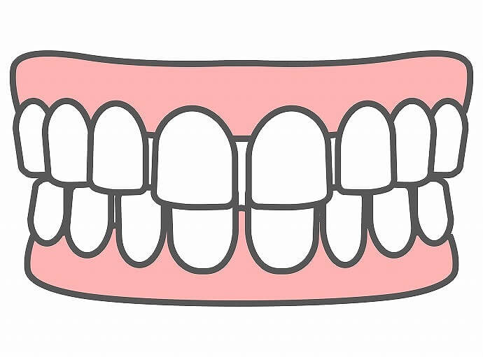 すきっ歯(空隙歯列)